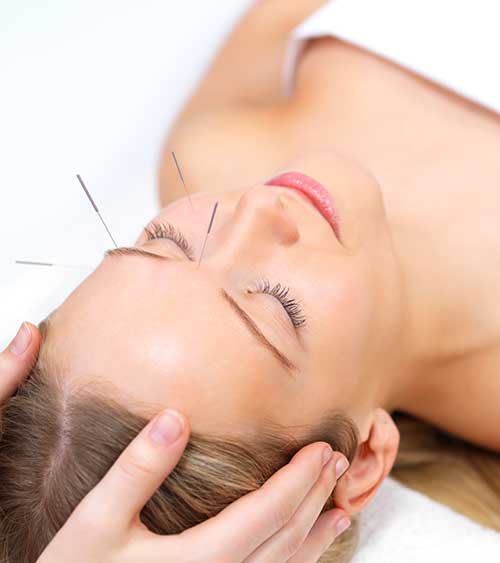 Acupuncture therapy for headaches